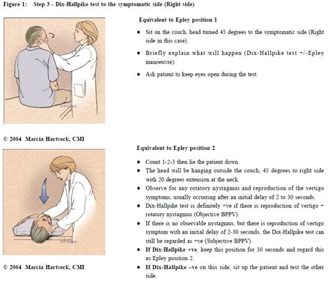 Epley Maneuver Image