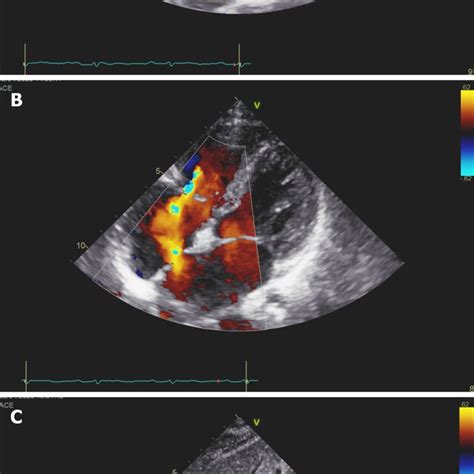 Transthoracic Echocardiography Showed Secundum Atrial Septal Defect