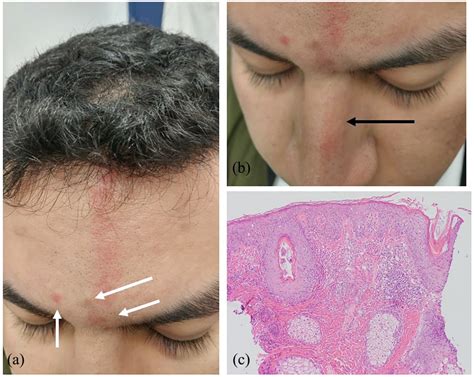 Neurodermatitis Scalp