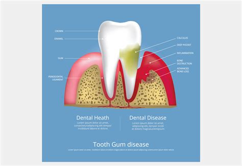 Human Teeth Stages Of Gum Disease Vector Graphic By Pongpongching