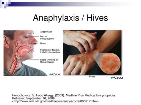 Anaphylaxis Rash / Anaphylaxis, An Overview - Health And Medical ...