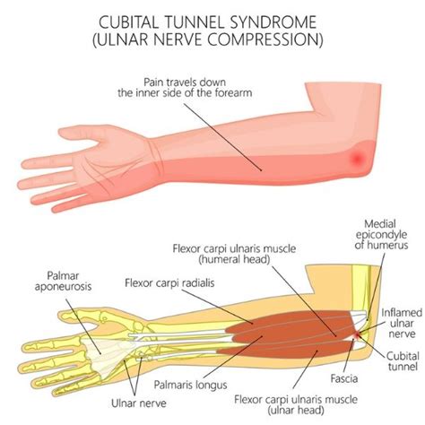 Ulnar Nerve Injury Ulnar Nerve Ulnar Nerve Entrapment Nerve Entrapment