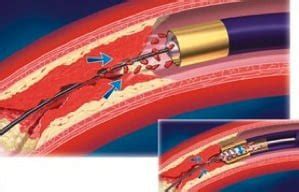 Paucis Verbis Card Acute Limb Ischemia