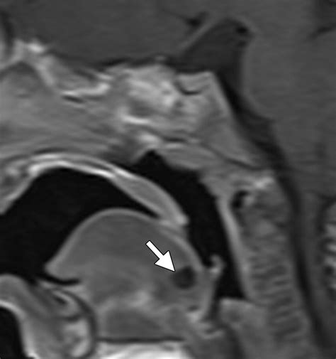 Imaging Of Ectopic Thyroid Tissue And Thyroglossal Duct Cysts