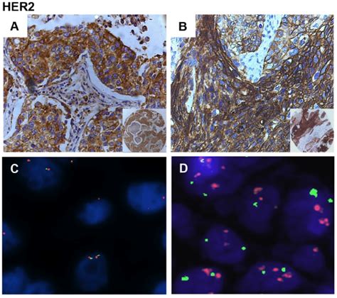 Immunostaining And Fish Analysis Of Her In Nsclc A Representative