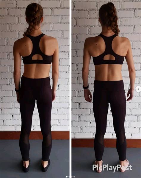 Scoliosis Before And After Yoga