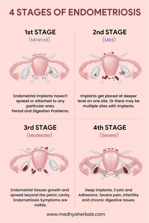 Endo Belly Endometriosis At Joshua Lipps Blog