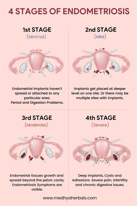 Endometriosis Symptoms 5 Early Signs You Shouldnt Ignore