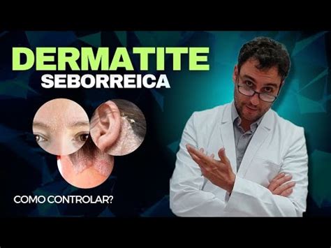 Como Controlar A Dermatite Seborreica YouTube