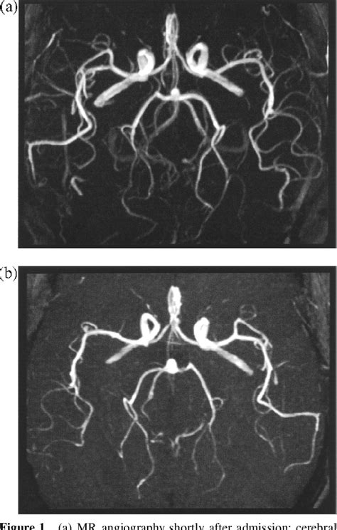 Figure 1 From Cerebral Vasculitis In A Patient With Hereditary Complete