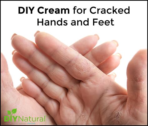 Cream for Cracked Hands and Feet: A DIY Natural Recipe