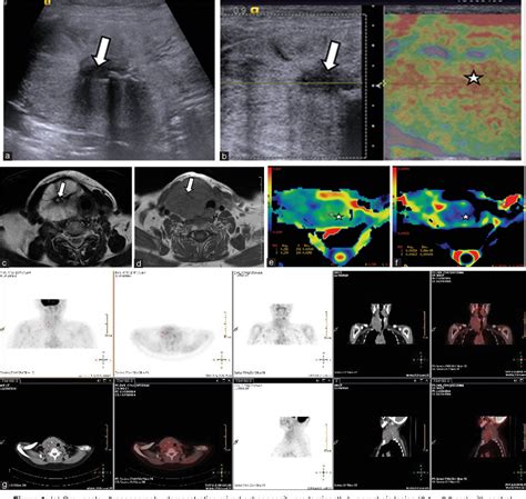 Figure From Multimodality Molecular Imaging Fdg Pet Ct Us