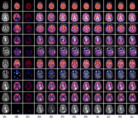 Multimodal Fusion Results Of Real Neurological A Mr Images B Spect