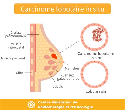 Cancer Du Sein Lobulaire Carcinome Lobulaire Infiltrant