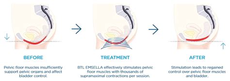 Emsella Urinary Incontinence Dearborn Aesthetic Medica Dearborn