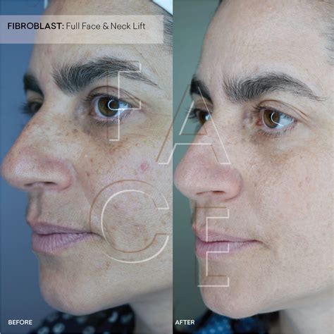 Plasma Fibroblast Before And After Results Oakland And La — Face