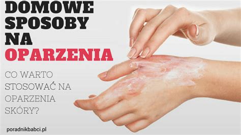 Co na oparzenia skóry 100 skuteczne Domowe sposoby na oparzenia