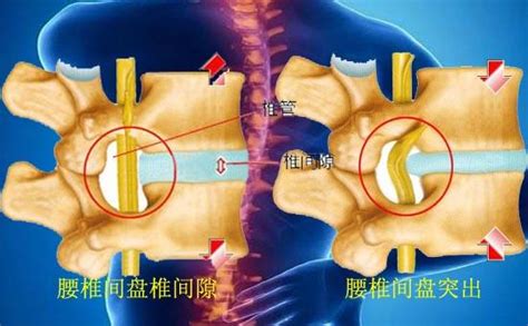 腰椎間盤脫出可以保守治療嗎？專家：病變壓迫神經應儘快手術 每日頭條