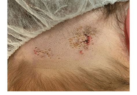 Nevus Comedonicus Plaque Like Lesion With Wide Open Follicles On The