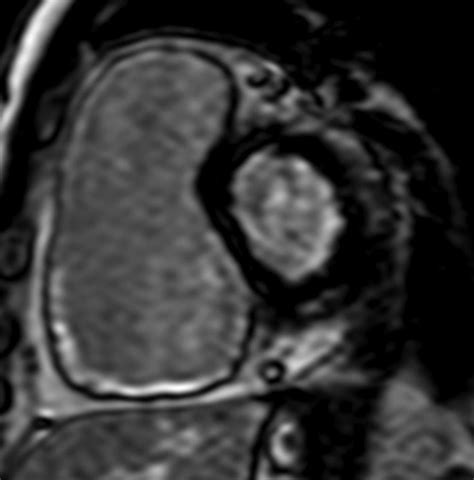 Cardiac MRI in this Era - Indian Journal of Cardiovascular Disease in Women