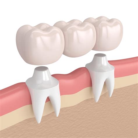 Dental Bridge Tooth Crowns And Bridges Auckland Cm Dental