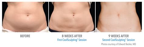 Coolsculpting Treatments In Rochester Ny Helendale Dermatology