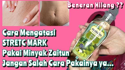 Cara Mengatasi Stretch Mark Di Betis Hilangkan Stretch Mark Dengan