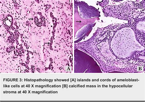 Figure From Ameloblastic Fibro Odontoma Of The Posterior Mandible A