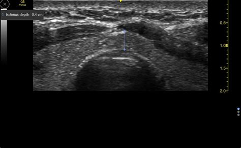 Isthmus Thyroid Ultrasound