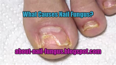 What Causes Nail Fungus? - About Nail Fungus