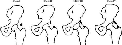 Brooker Classification For Heterotopic Ossification Download Scientific Diagram