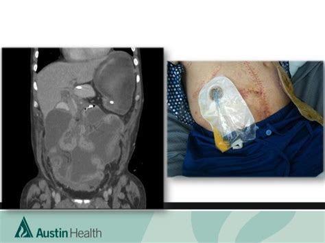 Intestinal Transplant: Overview and Australian Perspective