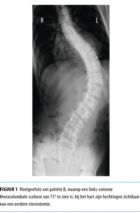 Scoliose Bij Kinderen Met Het 22q112 Deletiesyndroom Ntvg