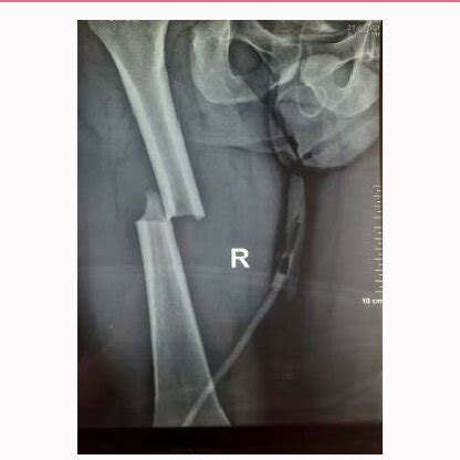 AP X-ray of the right femur, demonstrating a diaphyseal femur fracture ...