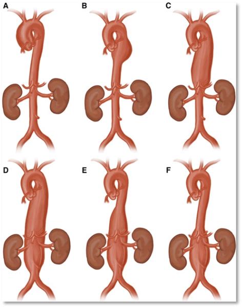 Aortic Aneurysms Dr Krasopoulos