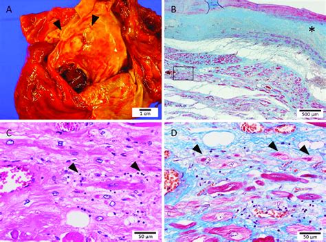 Macroscopic And Microscopic Autopsy Findings In A Patient With