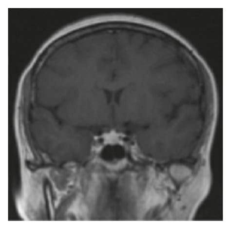 Dynamic Magnetic Resonance Imaging Mri Of The Pituitary Download