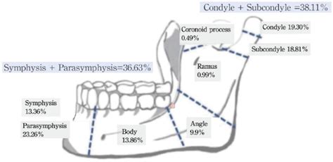 Distribution Of Mandibular Fracture Stratified By Dingman And Natvig