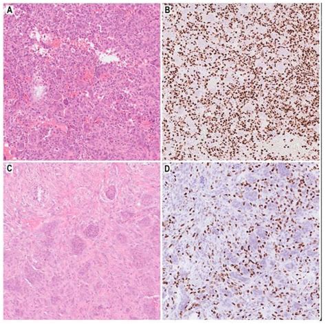 Cancers Free Full Text Denosumab In Giant Cell Tumor Of Bone