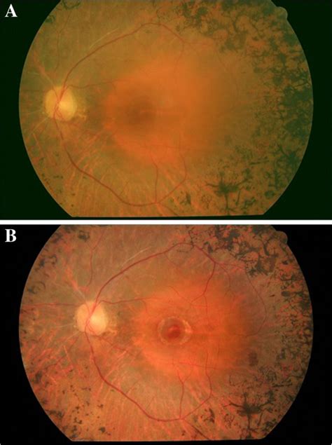 Fundus Photograph Of Left Eye 2 Months After Vitrectomy Showing The Download Scientific