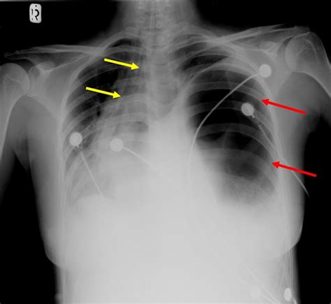 Diaphragmatic hernia – Radiology Cases