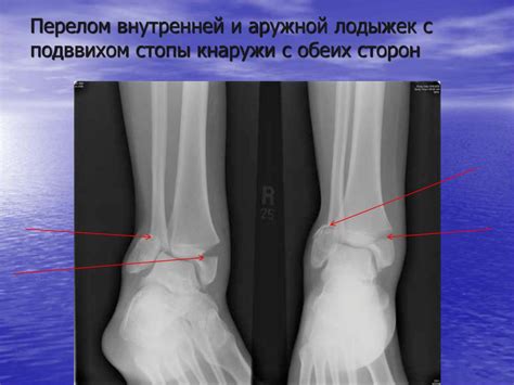 Рентген-диагностика повреждений голени и голеностопного сустава ...