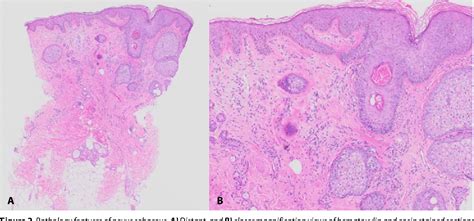 Figure From Nevus Sebaceus With Syringocystadenoma Papilliferum