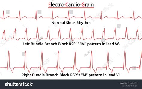 Set Of ECG Common Abnormalities Left Bundle Royalty Free Stock