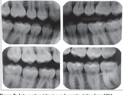 Figure From Dental Human Identification Using Bitewing Radiographs