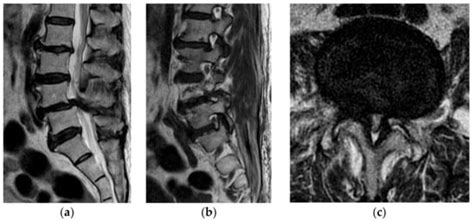 Brain Sciences Free Full Text Clinical Outcomes Of Biportal