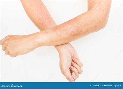 Skin Rashes Allergies Contact Dermatitis Allergic To Chemicals Coloso