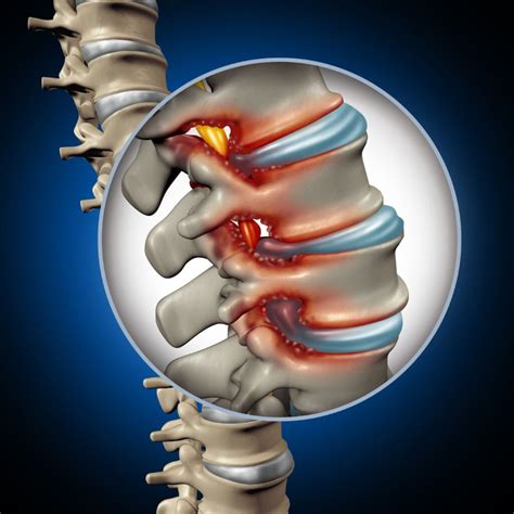 Lumbar Spinal Stenosis