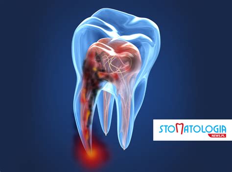 Zapalenie Miazgi Z Ba Objawy Przyczyny Leczenie Stomatologianews