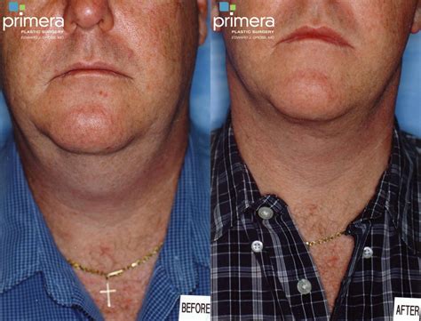 Neck And Face Liposuction For Men In Orlando